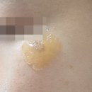 (주)피코 | 색소침착 피부과 레이저 내돈내산 후기: 광대 색소침착 흑자 기미 피코토닝 후기(feat. 주의사항)
