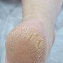 케어메디칼 | 청주발관리 잘하는 곳 메디컬풋케어 후기