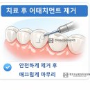 올바른 현치과의원 | 수원정자동교정치과, 현치과교정과 - 인비절라인 교정치료 시 치아에 붙이는 장치? (feat. 어태치먼트)