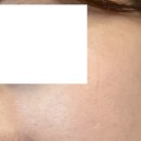 815의원 | [압구정/병원후기] 루비레이저로 유명한 압구정 루나의원 주근깨 제거 후기(815방..6개월 뒤 근황...