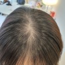 갈마동푸른아파트경로당 | 대전smp잘하는곳, 대전두피커버, 대전헤어라인교정 [온화혜 뷰티] 가르마커버 이게 된다고요?