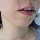 (의)광혜원한방병원 | 강남한방피부과 새살침 수술흉터치료 1회차 후기(전후/통증) 약혐주의