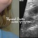 갑상설관낭종[thyroglossal duct cyst] 이미지