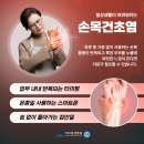 걸포북변역정형외과 손목 돌릴 때 '딸깍'거리는 소리, 주부 손목 질환의 원인은? 이미지