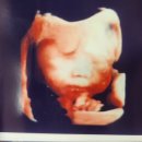 중앙대학교 | 18주차 신경관 결손 고위험군 중앙대학교 김광준 교수님 정밀초음파 후기