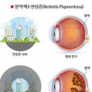 희귀병 망막색소변성증 증상 원인 이미지