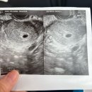 진해서울약국 | 유전자 질환으로 인한 시험관 (VHL / 착상전 유전자검사 / 서울역차병원 / PGT-A, PGT-M, 이식 후기)