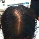 엔젤아이의원 | 쌍문역 엔젤아이의원 탈모 치료 후기👀 확실하게 느낀 변화!