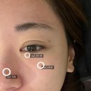 [선정릉 피부과] 강남 선정릉 피부과 피코토닝후기 잡티 기미 토닝
