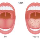 입천장 부음 통증 아픔 따가움이 느껴져요 이미지