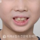 궁인덕치과의원 | 검단신도시 성장기 교정치과 | 8세 남아 영구치 공간 부족·구호흡, 1차 교정으로 턱 성장 방향 개선
