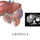 간 혈관종 원인 증상, 치료 수술 이미지