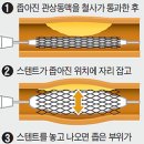 '스텐트 시술 꼭 할 필요 없다' 이미지