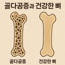이플란트지연치과의원 | [아산 연세원치과]치과 가기 전 '아스피린·골다공증 약' 드신다면 꼭 말씀해 주세요