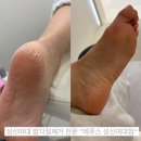 레푸스 성신여대점 | 겨울철 발각질관리 전문 &#34;레푸스 성신여대점&#34;에서 발케어받고 오기