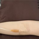 강서케이병원 | 대상포진 치료 후기 얼굴 대상포진 전문병원 입원 한 썰