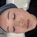 엘비드 | 인천피부관리 | [비비드엘 인천점] 에서 제로모공 시술 받고 피부 속 콜라겐 &amp; 탄력이 다시 살아난 찐 후기