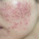 행복한의원 | 대구 해율한의원 패인흉터 치료 (새살침 후기)