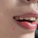 미라인의원 | 아나운서의 자신감, 환한 미소로 완성하다: 강남 미라인치과 라미네이트 후기