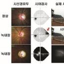 녹내장 초기 원인 30대 녹내장 이미지