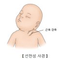 선천성 사경[Congenital (sternomastoid) torticollis]근골격질환, 소아청소년질환 이미지