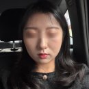 슈가성형외과의원 | 강남역 온다리프팅 볼살,이중턱 시술 후기