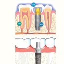 임플란트 종류 및 올바른 양치질 하는방법 이미지