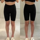 신논현필러 전문병원 힙딥필러 시술받은 리얼후기