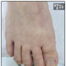 수원더셀의원 | 수원더셀의원에서 내성발톱 치료후기 | 걸을 때 통증 완벽 해결