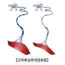 근위축성측색경화증(Amyotrophic lateral sclerosis) 이미지