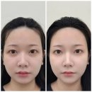 조이헤어라인 - 성남시 수정구 | [건대/군자] 최근에 받은 헤어라인 관리 후기 전해드려요 👩‍🦰