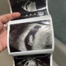 엄사보건지소(1층) | [작은 기적_2] 임산부 필수! 임신 초기검사(산전검사) 후기