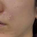 예스리더스의원 | 울산 비립종제거, 내돈내산 후기 💎