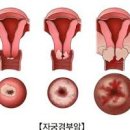 자궁암 초기 증상부터 검사 방법 기간까지 한눈에 정리 이미지