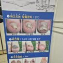 레푸스 구월점 내성발톱 무좀발톱 발각질 문제성발 이미지