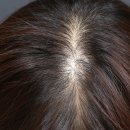 강서병원 | 강서구탈모치료 후기, 탈모전문병원 리제네라 두피메조 5개월차 효과 정리