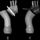 Simplified Cerebral Protection Using Unilateral Antegrade CerebralPerfusion and Moderate Hypothermic Circulatory Arrest 이미지