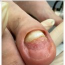 평택무좀발톱 1:1 꼼꼼한 관리 무드비네일 닥터아이티엔 화성점 내성발톱 무좀 발각질