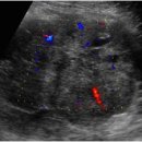 Yolk sac or endodermal sinus tumo 이미지