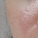 치료]내돈내산 주사피부염과 여드름 치료후기(피부과, 한의원, 굿지몰 유황비누, 바이텍스, 리그난...