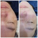 메타메디칼 | 동탄메타폴리스 붉은여드름 피부관리 이렇게 하세요.