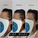 강동-천호-313 | 강동SMP 부작용걱정, 건성,지성,민감성두피