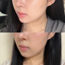 대치건강식품 | 대치역 피부과 티타늄리프팅 쥬베룩볼륨 볼패임 시술 후기, 티베룩으로 자연스러운 얼굴볼륨 완성