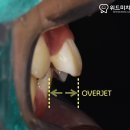 평택역 치과 발치교정 하면 입이 너무 들어간다던데, 정말 그럴까요?