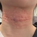 어린이대공원 제9호 화장실(남/녀) | 강남 신논현 목주름 필러 솔직 후기 + 경과