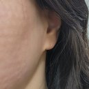 [내돈내산] 부산 스카이 피부과 리쥬란HB+ 통증, 엠보싱 후기
