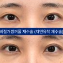 아이케이성형외과의원 네이버블로그