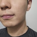 엠여성의원 | [부평 피부과] 남자 레이저제모 「엠공일의원」 내돈내산 후기