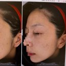 세븐일레븐 광주희망병원점 | 광주피부과전문의)여드름색소침착,잡티제거 토닝10회 내돈내산후기