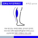 하지정맥류수술, 안전한 치료일까? ... 불안한데 괜찮을까요? 이미지